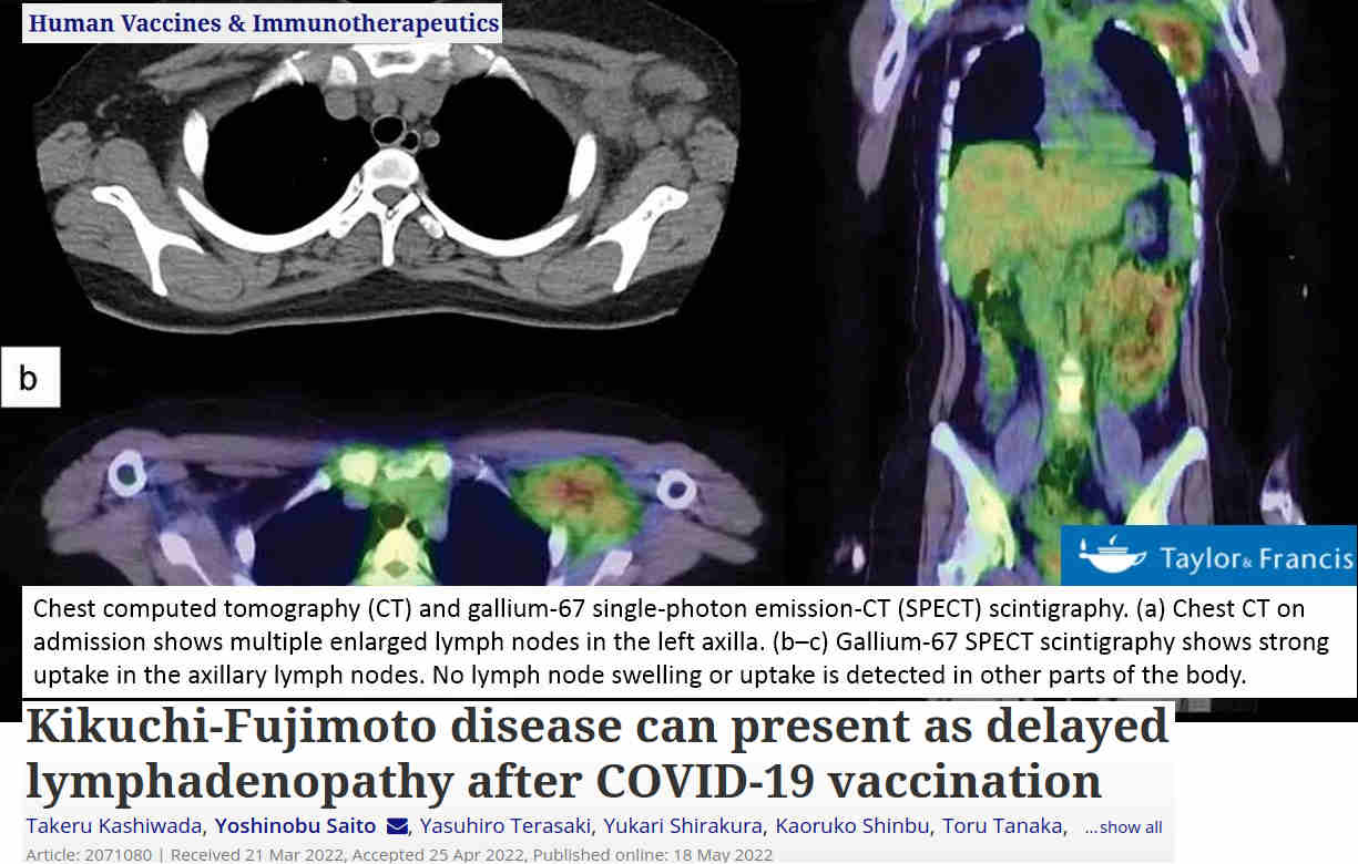 Necrotizing lymphadenitis, peruuttamaton imusolmukkeiden vaurio C19-injektion jälkeen.jpeg
