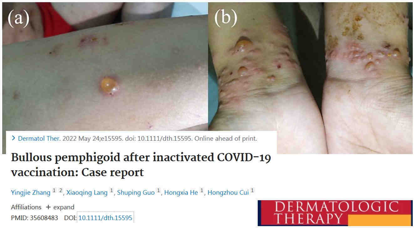 Rakkuloita aiheuttava autoimmuunisairaus bullous pemphigoid C19-injektion jälkeen.jpeg