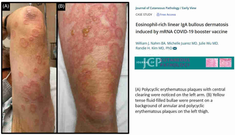 Rakkulainen bullous dermatosis mRNa-boosterista.jpg