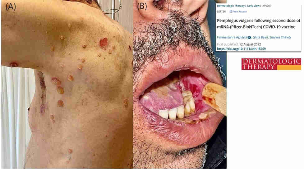 Pemphigus vulgaris -autoimmuunitauti toisen pfizerin jalkeen.jpg