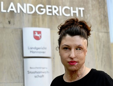 Vanessan kasvot tuhoutuivat ikuisesti. ZUMAWIRE.COM