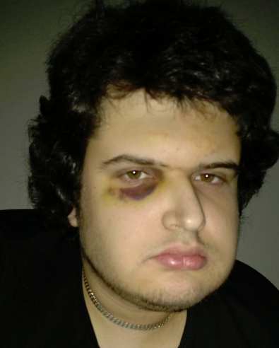 Lilo_hematooma.jpg