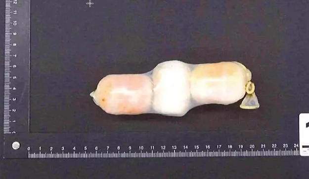Syyttäjän mukaan Subutex-pillereitä kuljetettiin kehon sisällä vankilaan muun muassa Kinder-munan sisäkotelossa, joka oli pakattu kondomiin.<br />Kuva: Poliisi / Esitutkintamateriaali